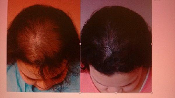 NUC PLASTICS PRP HAIR GROWTH