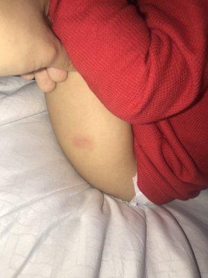 Two weeks after the vaccines were given, area was still red and slightly bumpy where needle was inserted