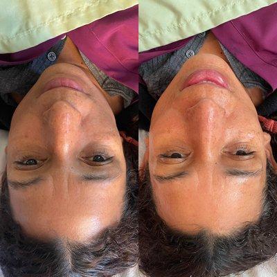 Before and after of a Hydroderm treatment.