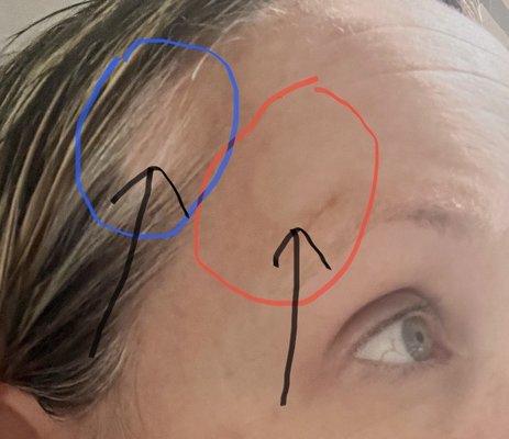 distinct tan line (red circle) and bald spot (blue circle).