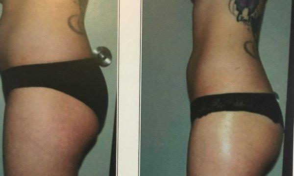 Before/After Body Sculpting Treatment