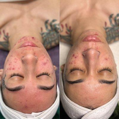 Before & After 
 client came in with cystic Acne & scaring these are results after just 3 sessions of Hydrofacial & LED Therapy