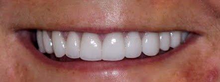 Veneer Case