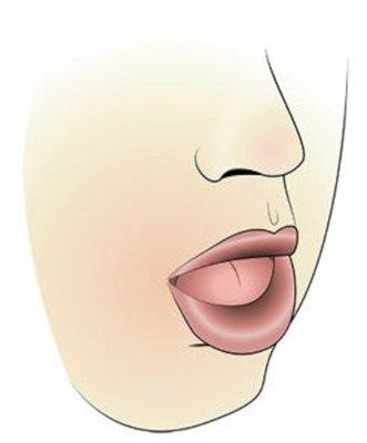 Open-mouth breathing posture and weak lip seal is extremely important to identify. Mouth breathing may be habitual or due to an obstruction.