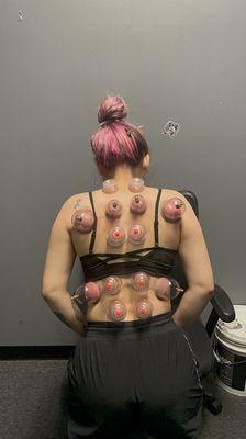 Cupping the back