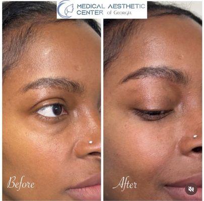 Under eye treatment to reduce under eye shadowing and puffiness using an injection intended to brighten the under eye area