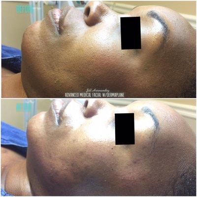 Advanced Medical Facial With Dermaplane Performed: by Lic Medical Esthetician Jill Hernandez Visit our website to book your service