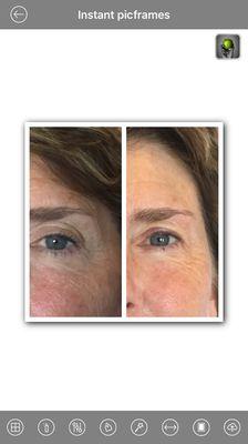 Lifted eyelid and brow line Micro-Current strengthen's facial muscles