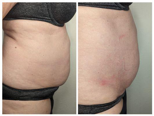 Stomach fat reduction before and after 1 treatment