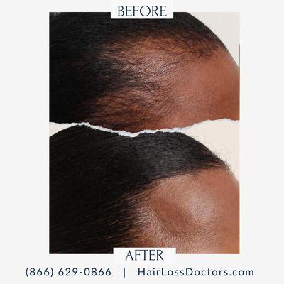 Female Before / After Sample from The Hair Loss Doctors By Robert J. Dorin with Surgical Headquarters in Garden City, NY.