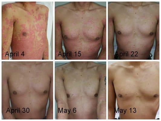 Progress Photo.
 Severe Psoriasis- Treatment with Acupuncture, Cupping, and Herbal Formula ONLY.