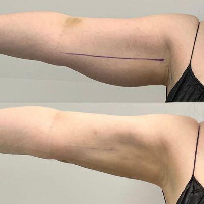 Arm Liposuction and J-Plasma Combination performed by Dr. Gevorgyan!