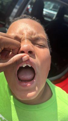 Two permanent teeth have to be replaced and his lip was burst open.