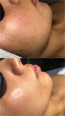 Dermaplane facial for smooth, hydrated, and glowing skin