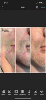 SkinPen Microneedling to diminish appearance of scar!