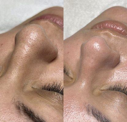 Hydro dermabrasion