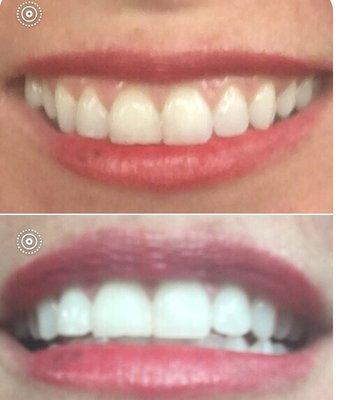 Super White Teeth Treatment