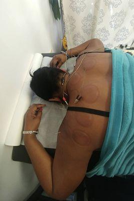 Cupping and Acupuncture treatment