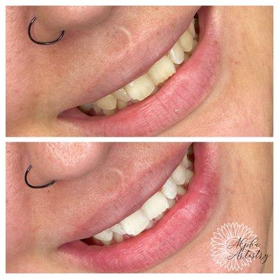 Teeth Whitening with only 1 session