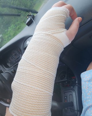 My fractured hand!