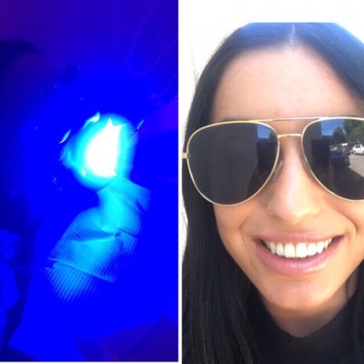 Laser Teeth Whitening - Amazing Results !