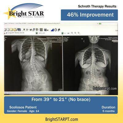 Schroth for Scoliosis Before & After