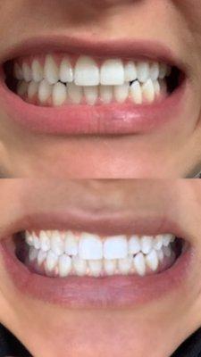 Teeth whitening