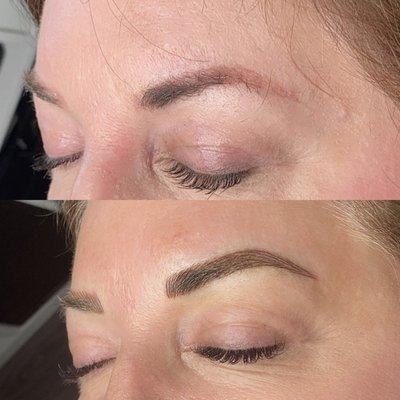 Brow Correction