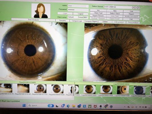 Iridology Consultation