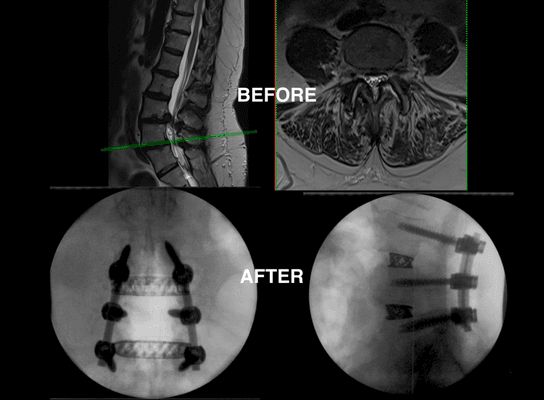 Minimally invasive lateral lumbar interbody fusion and posterior instrumentation