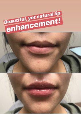 Lip Filler administered by Dr. Bo using Juvederm Vollure® for a beautiful, yet natural enhancement!