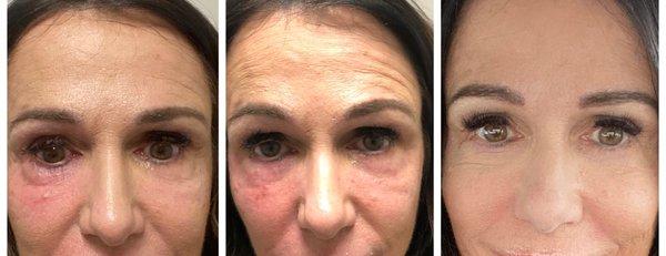 Before and After Botox Procedure on Forehead