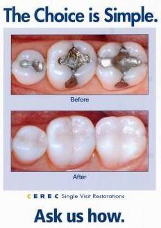 CEREC BEFIRE AND AFTER