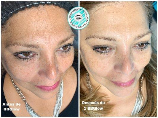 BBGLOW Rejuvenation Treatment