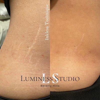 After ONE session of our Inkless technique for stretch marks - 4 weeks post treatment