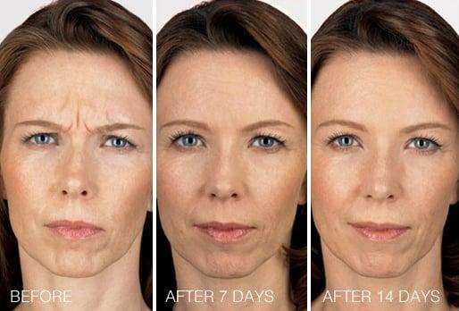 Botox Before & After (source: Allergan)