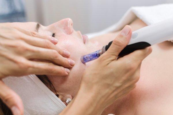 NEW! Microneedling, aka Collagen Induction Therapy is now offered in office