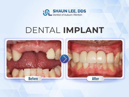 Shaun Lee, DDS Family Emergency Dental Implants of Auburn | 1320 8th St NE Ste. 103, Auburn, WA 98002 |(253)939-3440