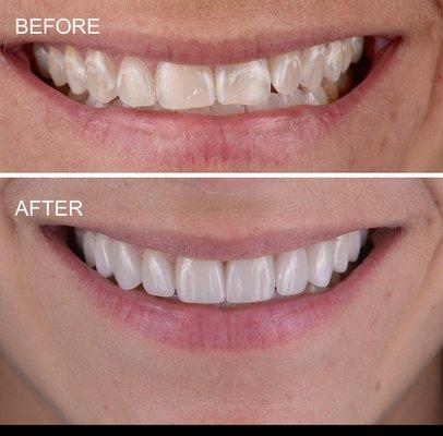 porcelain veneers