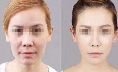 Ultherapy non-surgical face-lift treatment for full face