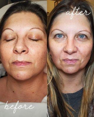 Amazing microdermabrasion facial results!