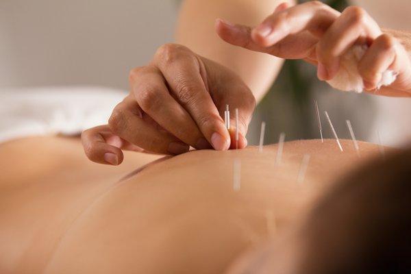 Acupuncture-pain treatment