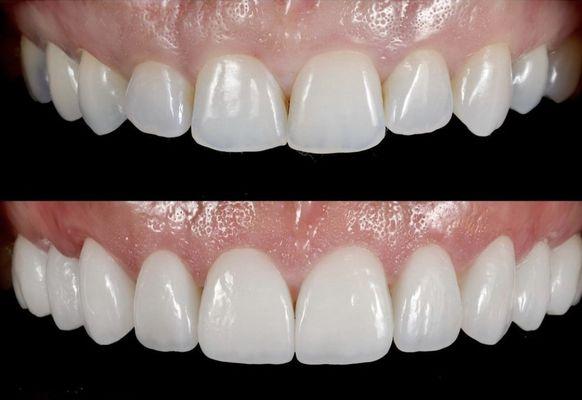 8 veneers will change your smile period!