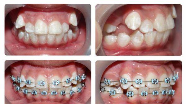 Heavenly Dental Smile Inc. - frenos dentales