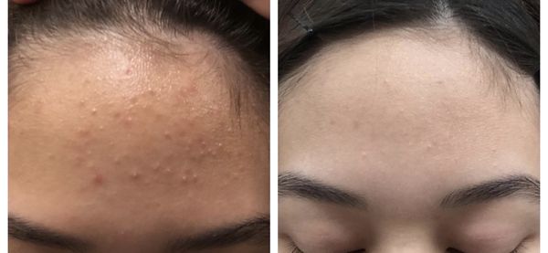 Before and after teen acne treatment. This is within a 3 month span and included a daily regimen.