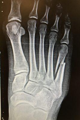 Foot fractures