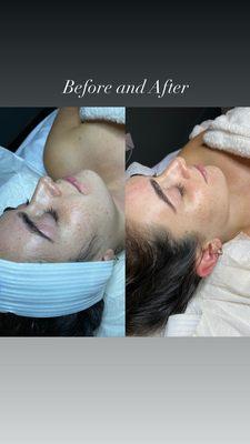 This client had Dermaplaning