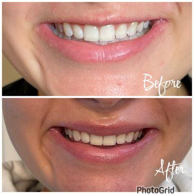 Beautiful lip flip results using Xeomin