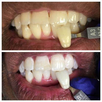 Before and After Zoom Whitening