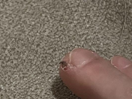 Gash left by an unsanitized drillbit, too large for such small toenails. Carelessly used, unsanitized. Saw naildust on it prior to use on me